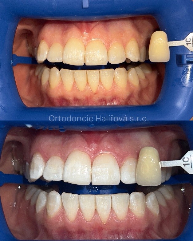 Kombinované bělení